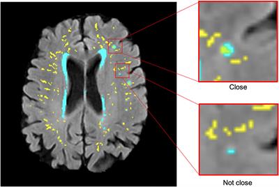Topological relationships between perivascular spaces and progression of white matter hyperintensities: A pilot study in a sample of the Lothian Birth Cohort 1936